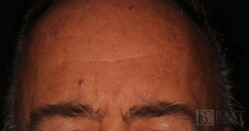 BOTOX® Cosmetic Before - Paramus, NJ