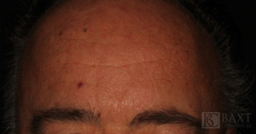 BOTOX® Cosmetic After - Paramus, NJ