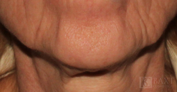 BOTOX® Cosmetic After - Paramus, NJ
