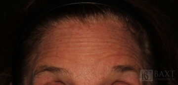 BOTOX® Cosmetic Before - Paramus, NJ