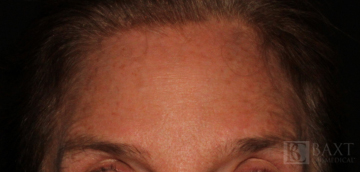 BOTOX® Cosmetic After - Paramus, NJ