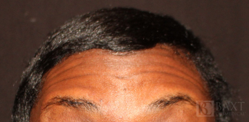 BOTOX® Cosmetic Before - Paramus, NJ
