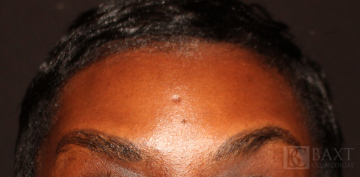 BOTOX® Cosmetic After - Paramus, NJ
