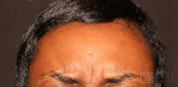 BOTOX® Cosmetic Before - Paramus, NJ