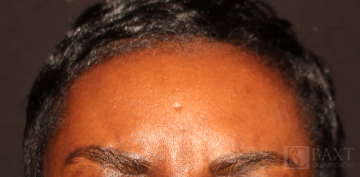 BOTOX® Cosmetic After - Paramus, NJ