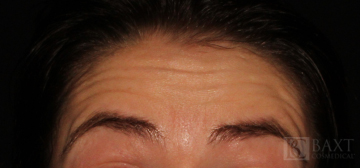 BOTOX® Cosmetic Before - Paramus, NJ