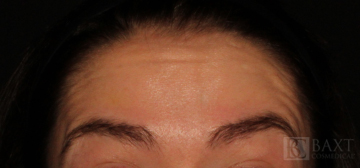 BOTOX® Cosmetic After - Paramus, NJ