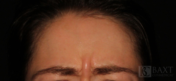 BOTOX® Cosmetic Before - Paramus, NJ