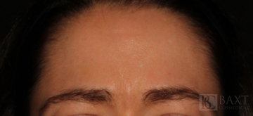 BOTOX® Cosmetic After - Paramus, NJ