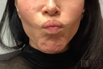 BOTOX® Cosmetic Before - Paramus, NJ