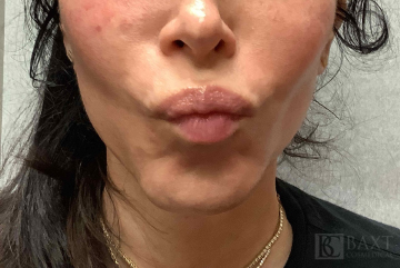 BOTOX® Cosmetic After - Paramus, NJ