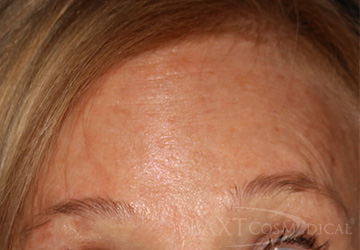 BOTOX® Cosmetic After - Paramus, NJ BOTOX® Cosmetic After - Paramus, NJ