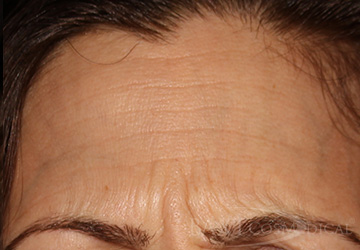 BOTOX® Cosmetic Before - Paramus, NJ BOTOX® Cosmetic Before - Paramus, NJ