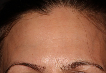 BOTOX® Cosmetic After - Paramus, NJ BOTOX® Cosmetic After - Paramus, NJ