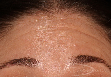 BOTOX® Cosmetic Before - Paramus, NJ BOTOX® Cosmetic Before - Paramus, NJ