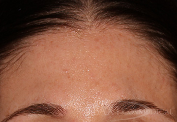 BOTOX® Cosmetic After - Paramus, NJ BOTOX® Cosmetic After - Paramus, NJ