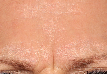 BOTOX® Cosmetic Before - Paramus, NJ BOTOX® Cosmetic Before - Paramus, NJ