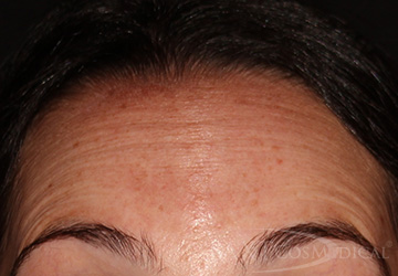 BOTOX® Cosmetic Before - Paramus, NJ