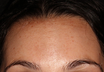 BOTOX® Cosmetic After - Paramus, NJ