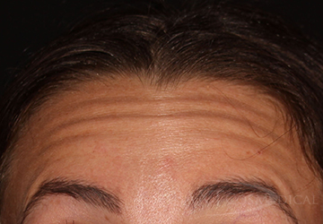 BOTOX® Cosmetic Before - Paramus, NJ BOTOX® Cosmetic Before - Paramus, NJ