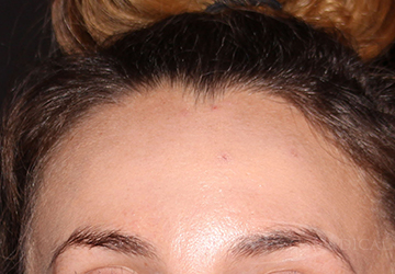 BOTOX® Cosmetic After - Paramus, NJ BOTOX® Cosmetic After - Paramus, NJ