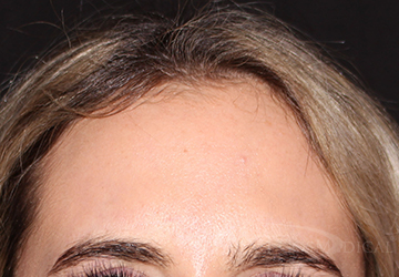 BOTOX® Cosmetic After - Paramus, NJ BOTOX® Cosmetic After - Paramus, NJ