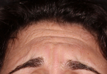 BOTOX® Cosmetic Before - Paramus, NJ BOTOX® Cosmetic Before - Paramus, NJ