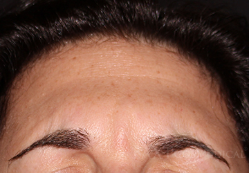 BOTOX® Cosmetic After - Paramus, NJ BOTOX® Cosmetic After - Paramus, NJ