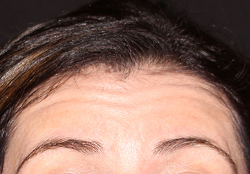 BOTOX® Cosmetic Before - Paramus, NJ BOTOX® Cosmetic Before - Paramus, NJ