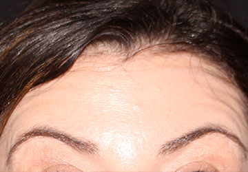 BOTOX® Cosmetic After - Paramus, NJ BOTOX® Cosmetic After - Paramus, NJ