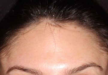 BOTOX® Cosmetic After - Paramus, NJ BOTOX® Cosmetic After - Paramus, NJ