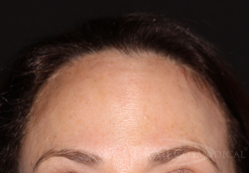 BOTOX® Cosmetic After - Paramus, NJ BOTOX® Cosmetic After - Paramus, NJ
