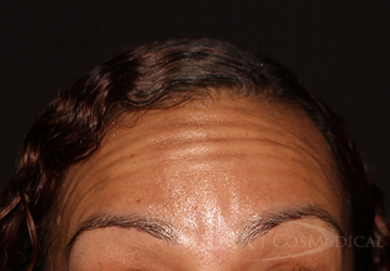 BOTOX® Cosmetic Before - Paramus, NJ BOTOX® Cosmetic Before - Paramus, NJ