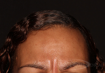 BOTOX® Cosmetic Before - Paramus, NJ BOTOX® Cosmetic Before - Paramus, NJ