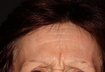 BOTOX® Cosmetic Before - Paramus, NJ BOTOX® Cosmetic Before - Paramus, NJ
