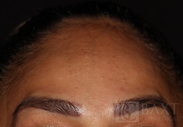 BOTOX® Cosmetic After - Paramus, NJ BOTOX® Cosmetic After - Paramus, NJ