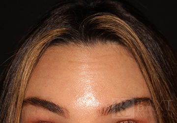 BOTOX® Cosmetic After - Paramus, NJ BOTOX® Cosmetic After - Paramus, NJ
