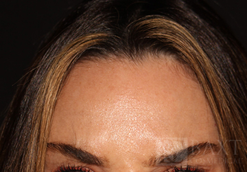 BOTOX® Cosmetic After - Paramus, NJ BOTOX® Cosmetic After - Paramus, NJ