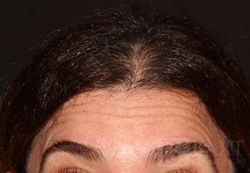 BOTOX® Cosmetic Before - Paramus, NJ BOTOX® Cosmetic Before - Paramus, NJ