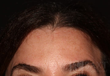 BOTOX® Cosmetic After - Paramus, NJ BOTOX® Cosmetic After - Paramus, NJ