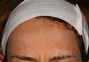 BOTOX® Cosmetic After - Paramus, NJ BOTOX® Cosmetic After - Paramus, NJ