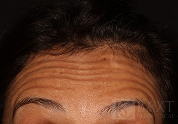 BOTOX® Cosmetic Before - Paramus, NJ BOTOX® Cosmetic Before - Paramus, NJ