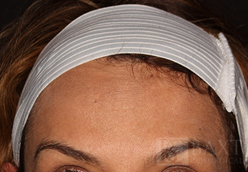 BOTOX® Cosmetic After - Paramus, NJ BOTOX® Cosmetic After - Paramus, NJ