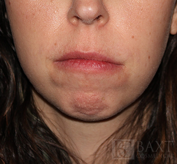 BOTOX® Cosmetic Before - Paramus, NJ BOTOX® Cosmetic Before - Paramus, NJ
