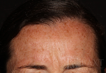 BOTOX® Cosmetic Before - Paramus, NJ BOTOX® Cosmetic Before - Paramus, NJ