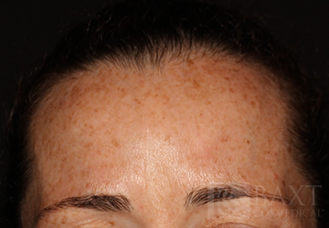 BOTOX® Cosmetic After - Paramus, NJ BOTOX® Cosmetic After - Paramus, NJ