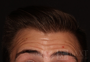 BOTOX® Cosmetic Before - Paramus, NJ BOTOX® Cosmetic Before - Paramus, NJ