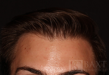 BOTOX® Cosmetic After - Paramus, NJ BOTOX® Cosmetic After - Paramus, NJ