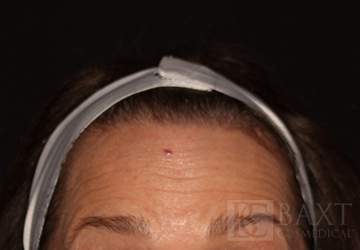 BOTOX® Cosmetic Before - Paramus, NJ BOTOX® Cosmetic Before - Paramus, NJ