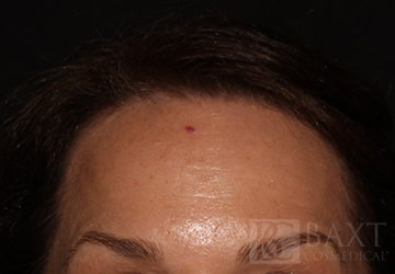 BOTOX® Cosmetic After - Paramus, NJ BOTOX® Cosmetic After - Paramus, NJ